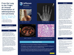 From the Lung to the Finger: An Unusual Presentation of Adenosquamous Cell Carcinoma