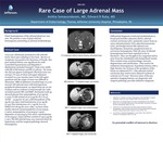 Rare Case of Large Adrenal Mass by Anitha Somasundaram, MD and Edward B. Ruby, MD